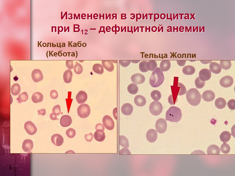 Изменения в эритроцитах  при В12 – дефицитной анемии Кольца Кабо (Кебота) Тельца Жолли